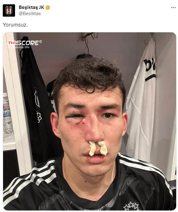 กังฟูฟุตบอล❓❓ผู้เล่นถูกทุบตีด้วยหน้าตาฟกช้ำดำเขียวระหว่างเกมในซือเปร์ลีก