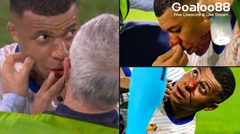 Euro 2024: France star Kylian Mbappé to avoid nose surgery